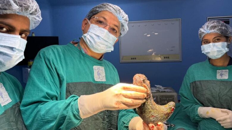 अपनी बाल नोंच कर खा गई महिला, पेट से निकला डेढ़ किलो का बाल का रोल, पेट के दर्द से परेशान थी महिला